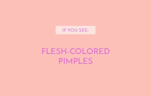Flesh-colored pimples