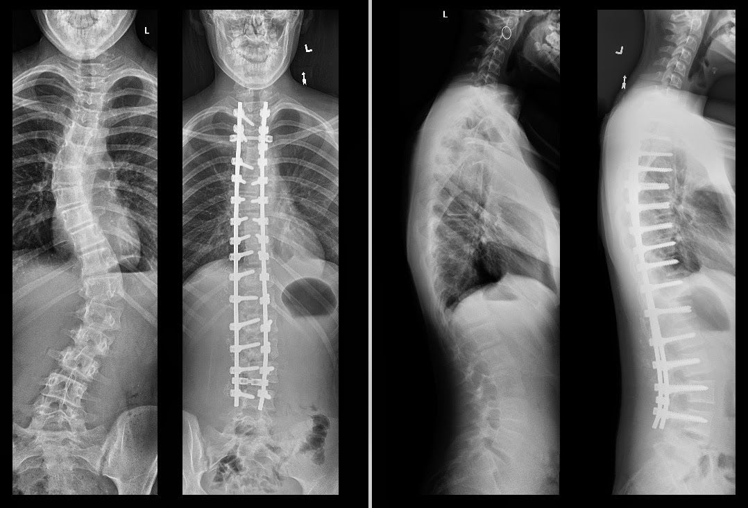 Shona on X: How cool is this?! Scoliosis (spinal fusion) surgery