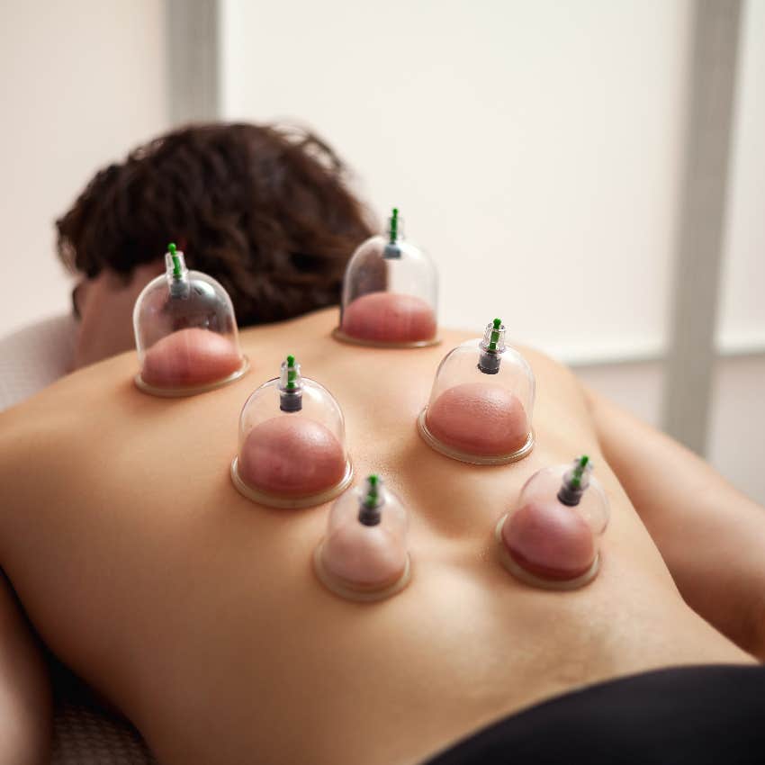 Cupping therapy