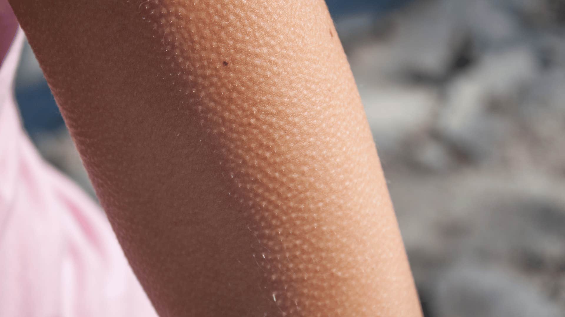 person with goosebumps