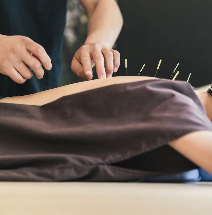 Person receives acupuncture treatment