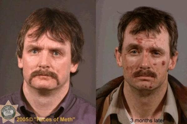 600px x 400px - The Devastating Before And After Photos Of Crystal Meth Addiction |  YourTango