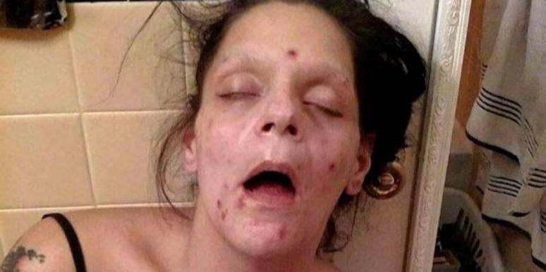 Recovering Addict Shares The Devastating Before And After Photos Of