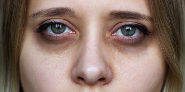 Puffy Eyes Definition Causes Symptoms and Treatment
